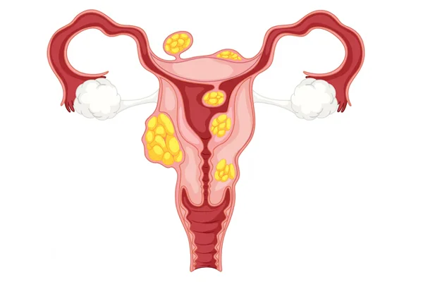 Fallopian Tube Blockage