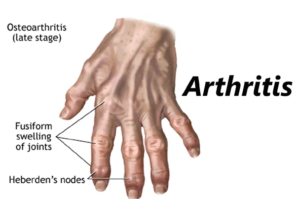 Arthritis