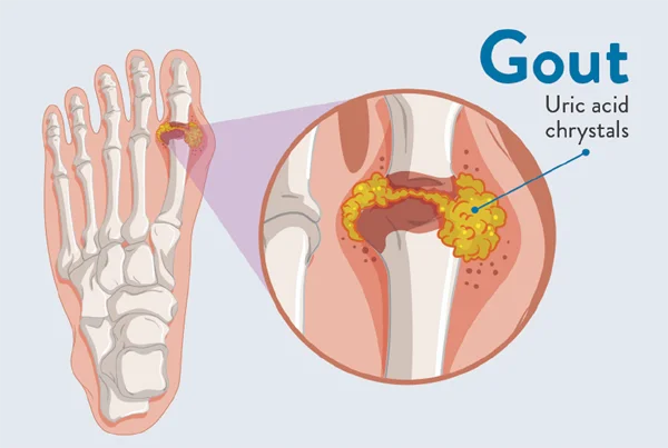 Gout