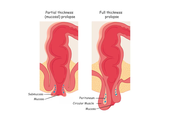 Prolapsed Rectum