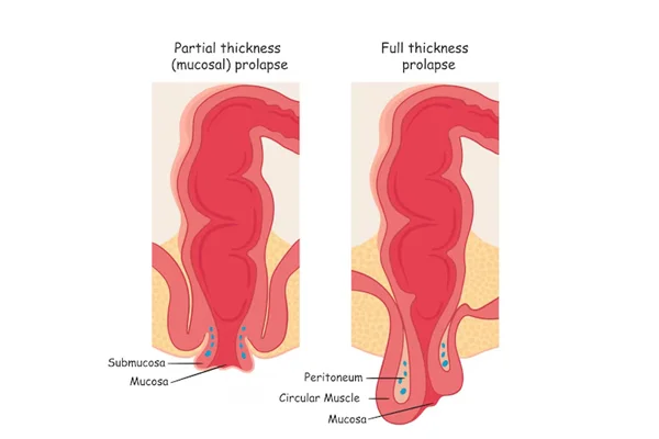 Prolapsed Rectum